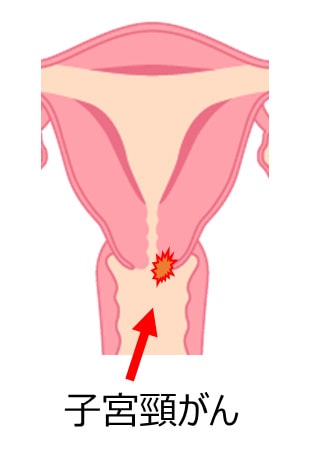 子宮頸がん